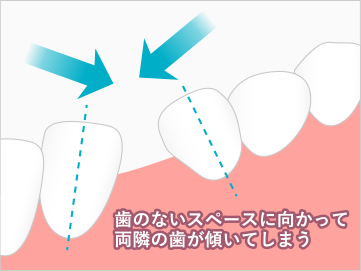 歯のないスペースに向かって両隣の歯が傾いてしまう