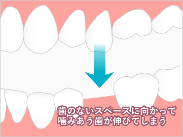 歯のないスペースに向かって噛みあう歯が伸びてしまう